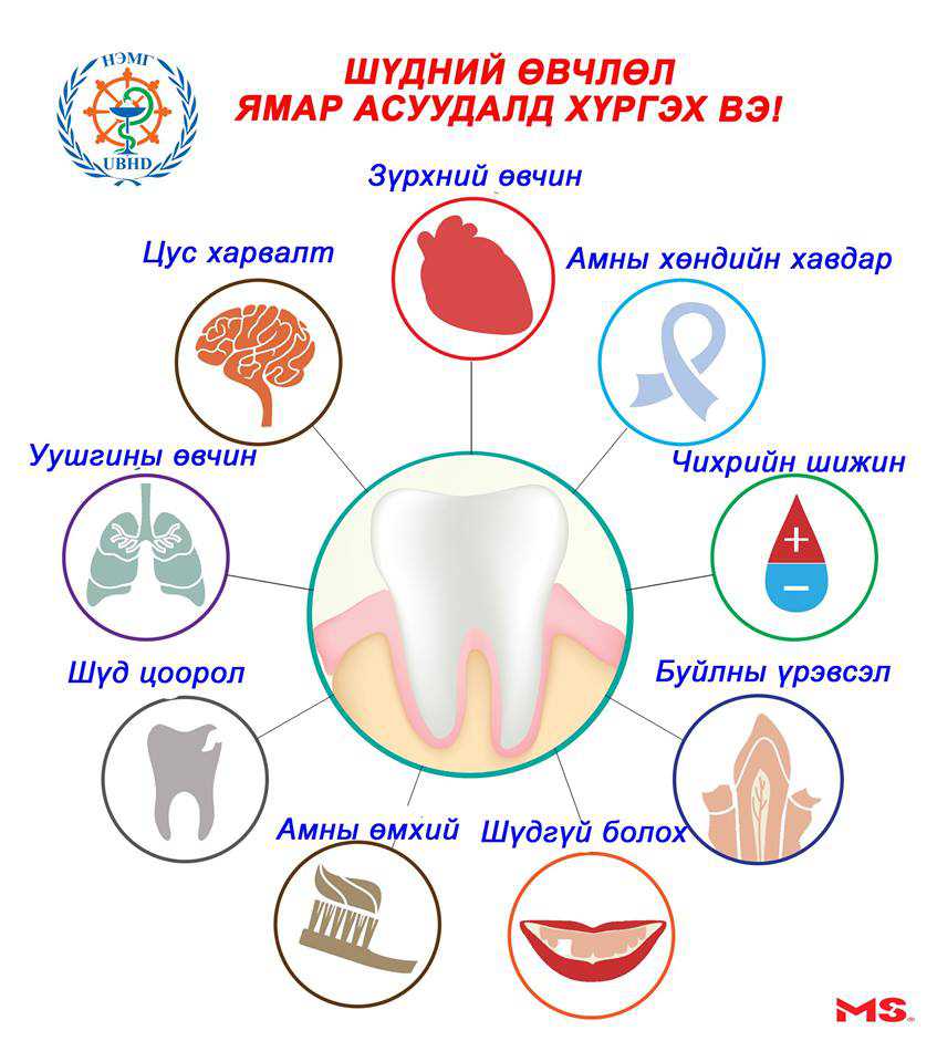 Шүдний өвчлөл хүний эрүүл мэндэд ямар сөрөг нөлөө үзүүлдэг вэ